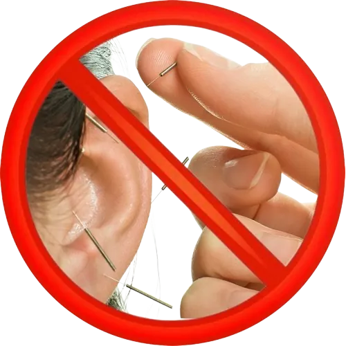 Aghi di agopuntura auricolare barrati